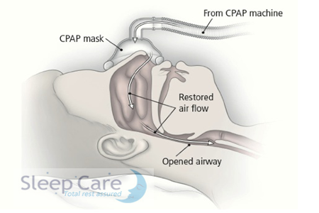 CPAP theraphy